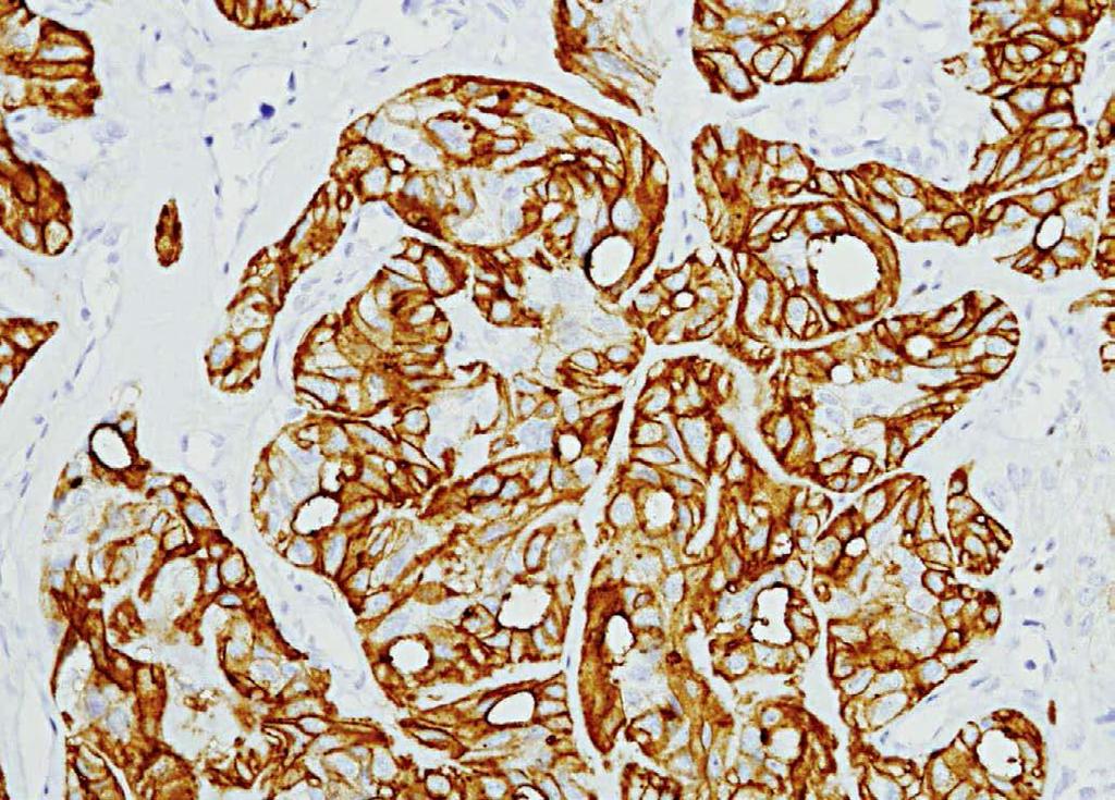 Hyalinizing Trabecular Tumor Dako MIB-1 monoclonal antibody: strong and diffuse