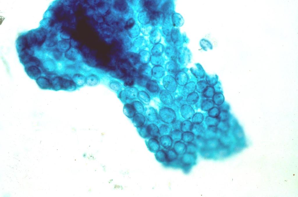 Cytology of Papillary Thyroid Carcinoma: Nuclear