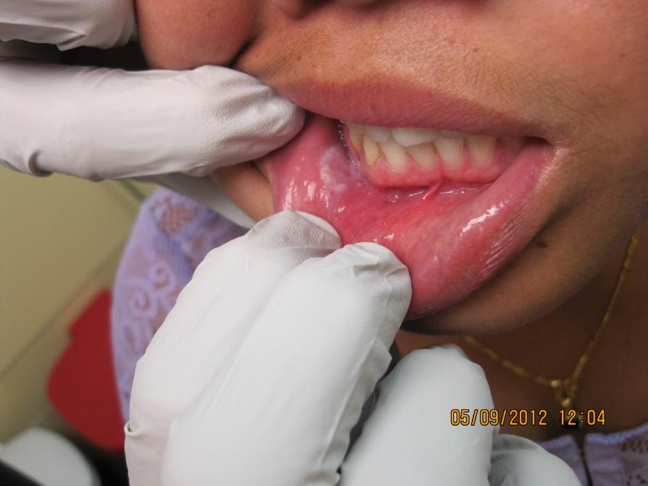 Oral Effects of Tobacco Use Tooth stains Altered taste and