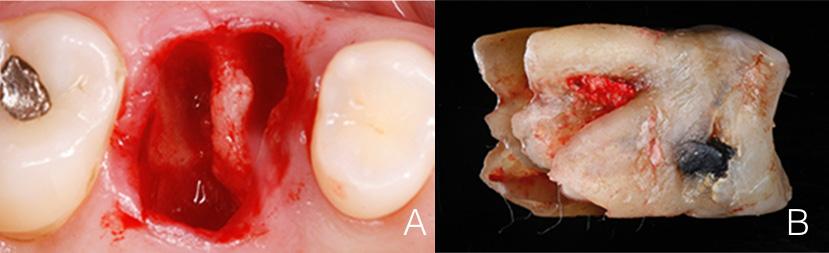 and extraction site when immediate implant placement is contraindicated (Jensen et al., 1998).