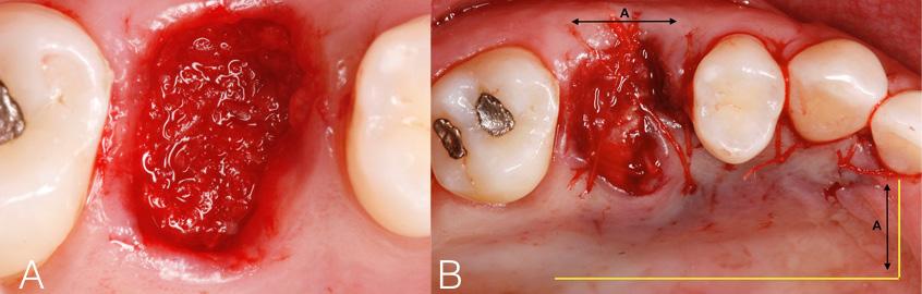 104 Journal of the International Academy of Periodontology (2016) 18/4 The extraction site was closed using the technique described by Nemcovsky et al. (1999).