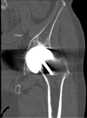 The 100 kev monochromatic image with MRs was able to show the implosion of implant into the joint space and producing pressure erosion of the articular surface of femoral condyle.
