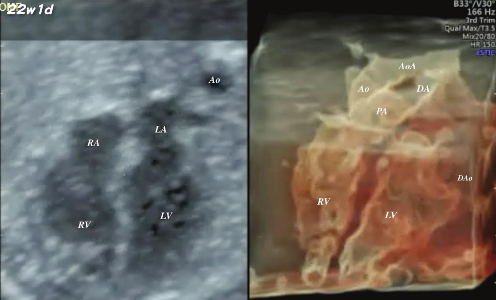 Figure 1. HDlive silhouette mode image of a normal fetal heart at 22 weeks 1 day.