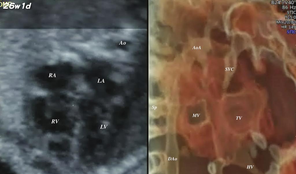HDlive silhouette mode image of the posterior view of a normal fetal heart at 26 weeks 1 day.