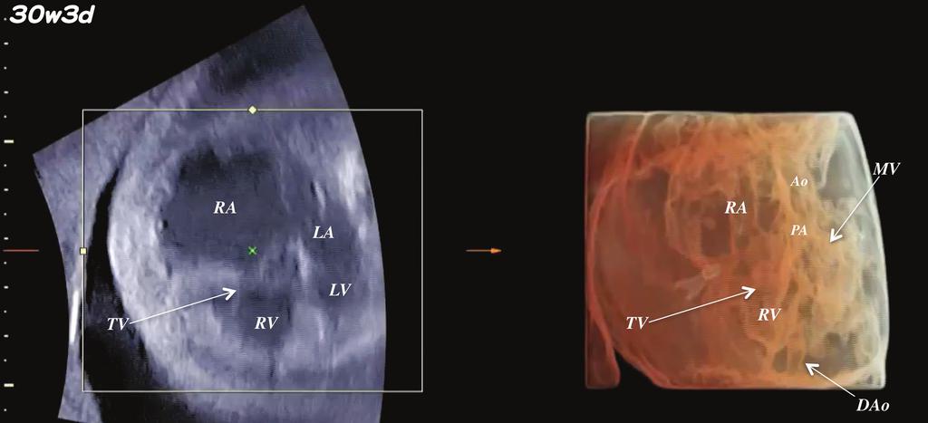 Figure 8. HDlive silhouette mode image of a fetal heart with Ebstein anomaly at 30 weeks 3 days.