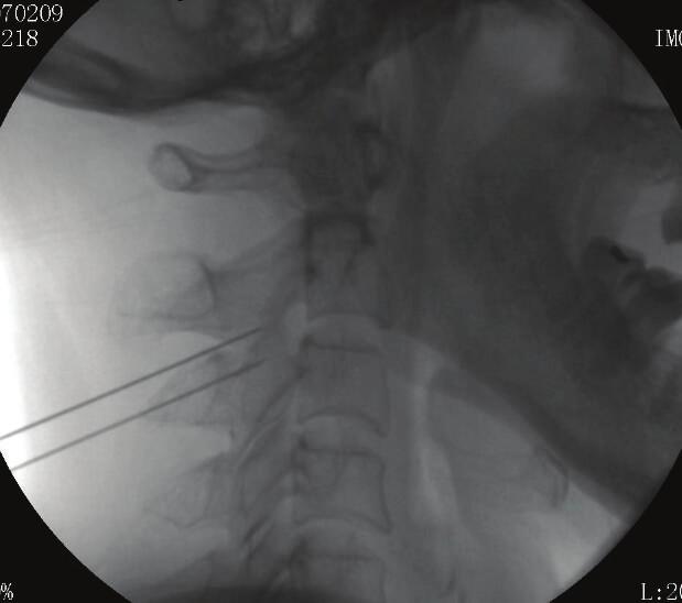 The first entry point was the intersection of the edge of the C2 vertebral bodies and the midline between the C2 and C3 levels. Lidocaine was injected hypodermically to provide local anesthesia.