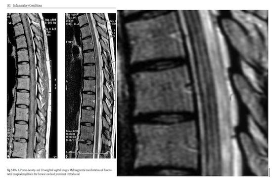 Figure 3.- Figure 5.97a and b, and in detail, taken from MRI Atlas Orthopedics and Neurosurgery The Spine. Martin Weyreuther and cols. Springer 2006.. Figure 4.