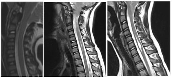 On the MR image of the cranio-cervical region on the left hand side, taken in 2010, patient two years old, two parallel lines that follow the centre of the spinal cord can be seen, medullary