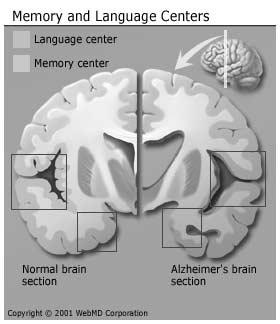 Alzheimer s Disease Types of Behavior Problems Disruptive Physically dangerous Psychological Psychotic Alzheimer s Disease Non-pharmacologic Management for Non-Cognitive Symptoms
