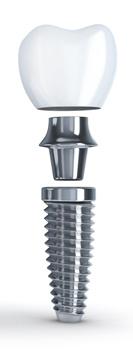 Anatomy of a Dental Implant Implants provide a strong foundation for replacement of missing teeth, whether singly, for multiple teeth, or as a sturdy base for bridges or dentures.
