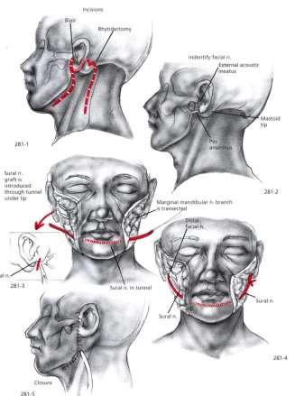 Restoration of Neural Input Cross-facial graft Sural interposition graft From distal branch of normal facial nerve to distal nerve stump