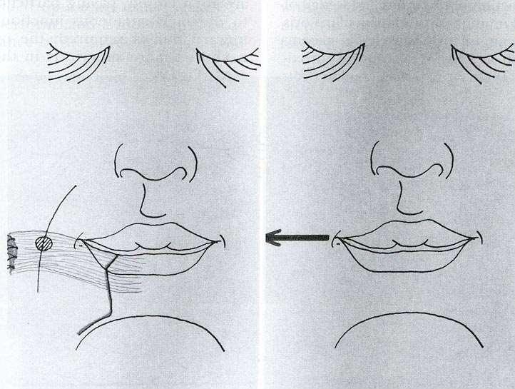 Adjunctive Procedures Lower lip wedge