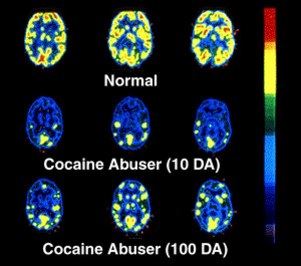 Your Brain After Cocaine Normal Cocaine Addict - 10 days drug free