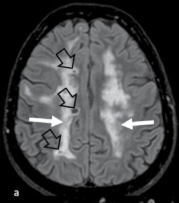 HR a b d c e f Fig. 1. a. Axial FLAIR image at the corona radiata level shows extensive confluent white matter lesions in both brain hemispheres (white arrows)
