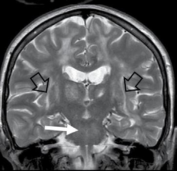Axial FLAIR image at the basal ganglia level illustrates the striking involvement of both external ca