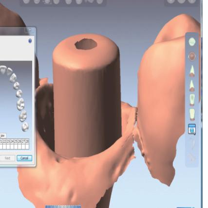Aforementioned CAD/CAM Abutments can be applicable to wide range of