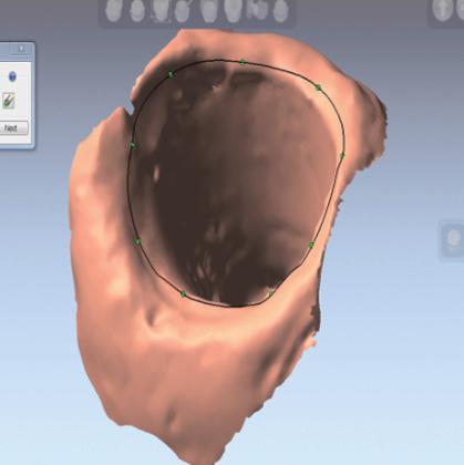 functional restorations of the posterior implants.