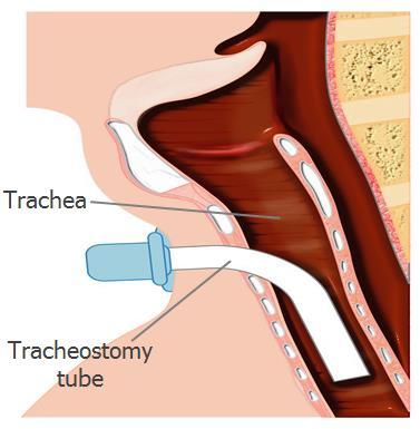A tracheostomy is a tube that goes into the windpipe (trachea) through the neck please see figure 1.