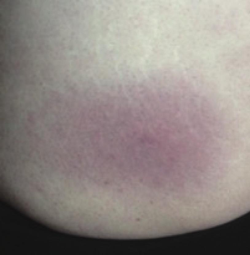 2 CaseReportsinInfectiousDiseases Figure 1: The patient noted an oval nonpainful red skin lesion on her left hip which was attributed to a drug reaction. a total white blood cell (WBC) count of 4.