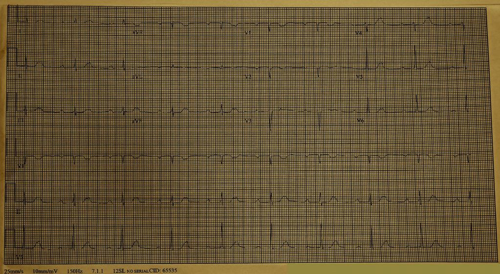Case Reports in Infectious Diseases 3 Figure 2: The patient s admitting EKG showing sinus tachycardia with second-degree AV block with 2 : 1 conduction.