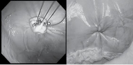 UWMC/GENERAL SURGERY Endoscopic view from above Full thickness visual below Figure 9.