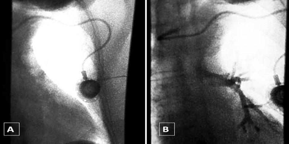 She underwent exploratory surgery where the catheter was reported to have emerged from the innominate vein through the anterior wall of the trachea.