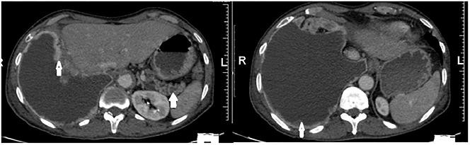 Fig. 1: CT Thorax and Abdomen showing Pleural Enhancement, Pleural Nodules (Arrow) and Effusion and Cystic Lesion in the Distal Body and Tail of Pancreas (Arrow). Fig.