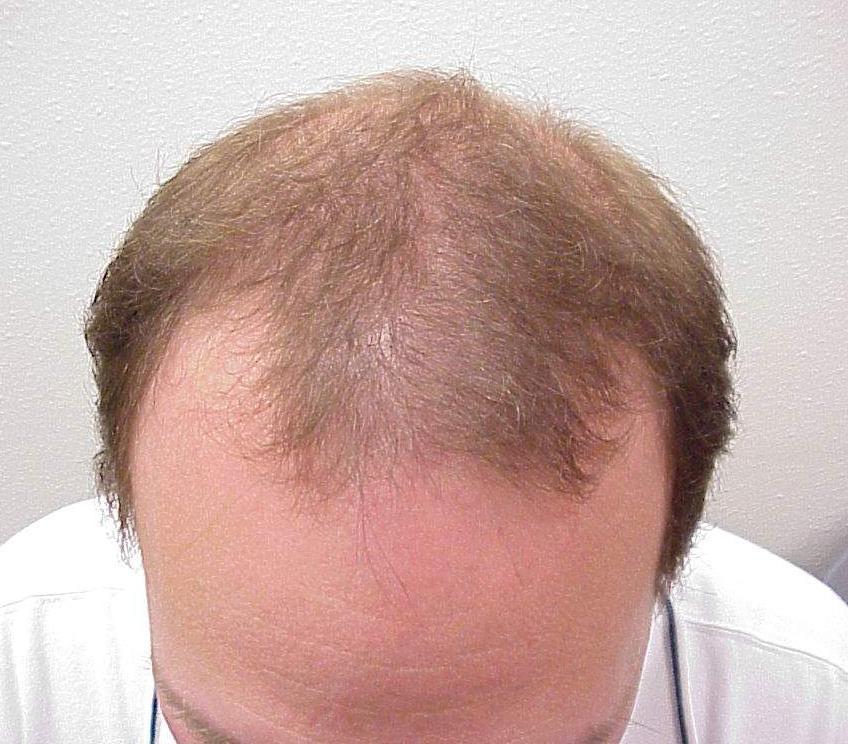 Androgenic Alopecia Multiallelic trait Obtain history of baldness in grandparents and 1