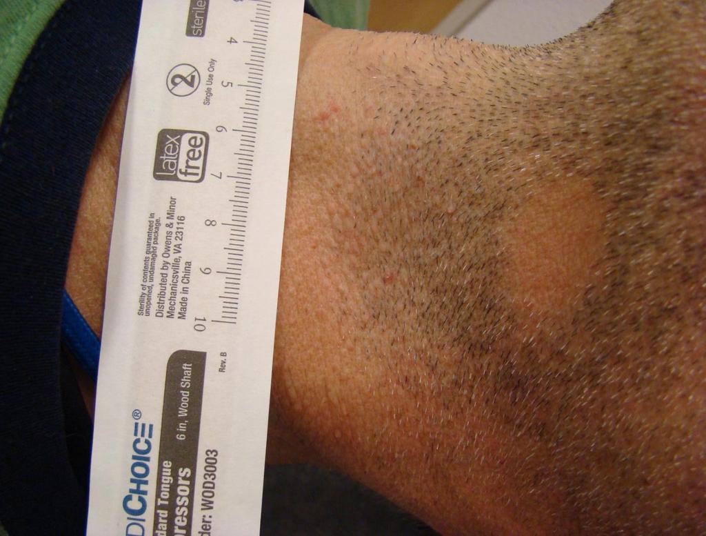 Alopecia Areata Focal patches Smooth base Easily pulled hairs at margin Non scarring Poss auto-immune Poss