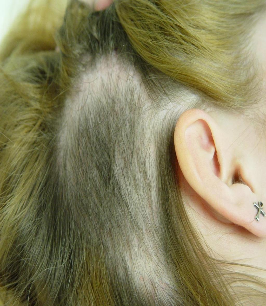 Trichotillomania Mean onset age 13 Dx usually by the pattern of