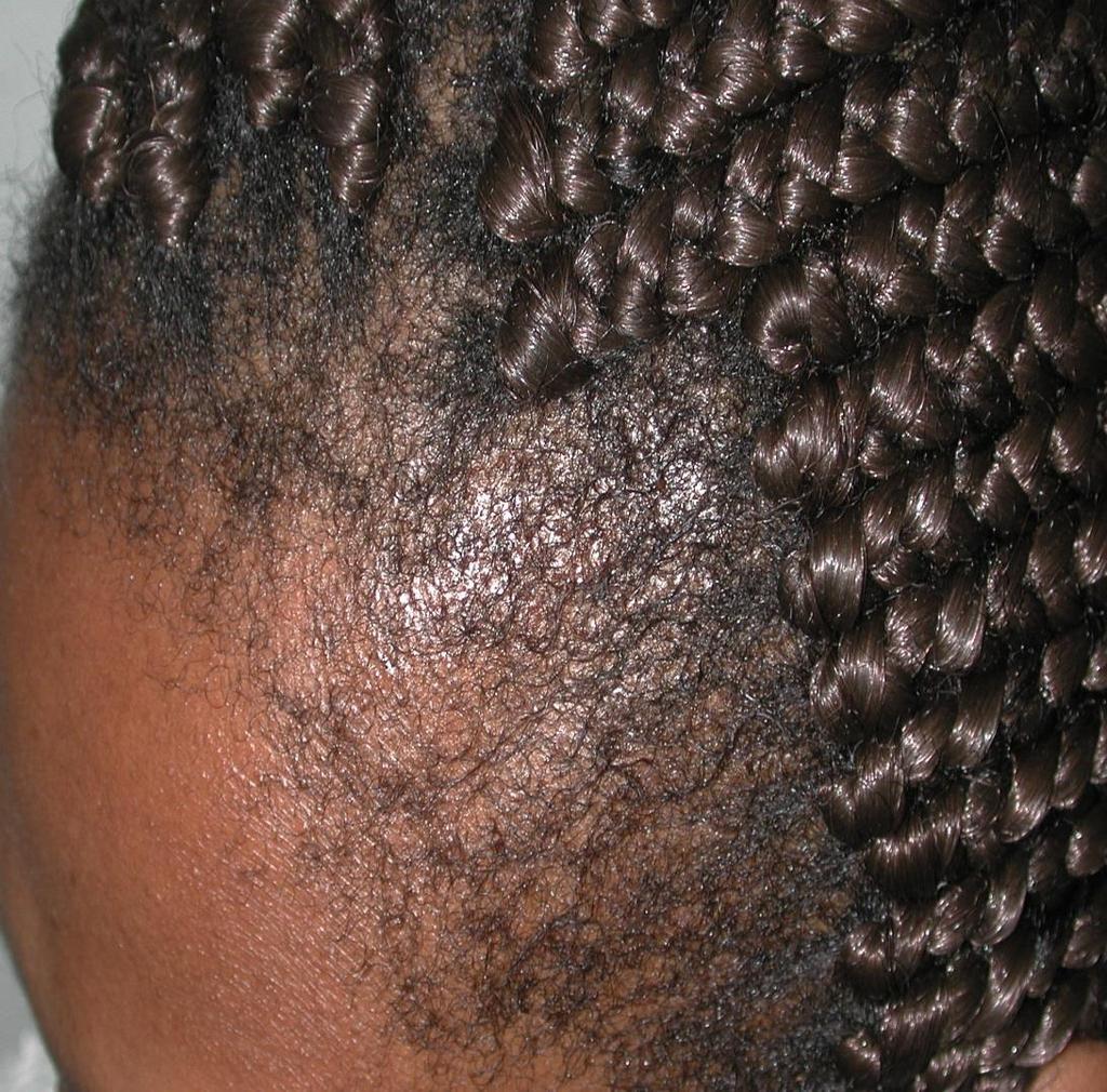Traction Alopecia Unintentional traumatic hair loss Often seen in athletes and African-Americans when hair is placed in tight braids / styles