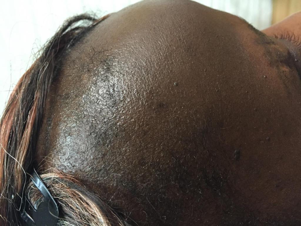 Traction Alopecia Temporal, frontal and periauricular regions