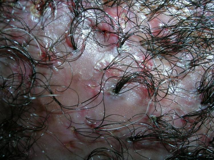 Scarring Alopecias Very heterogeneous group Trend to hair destruction in early or even mild stages of the disease Hair loss permanent