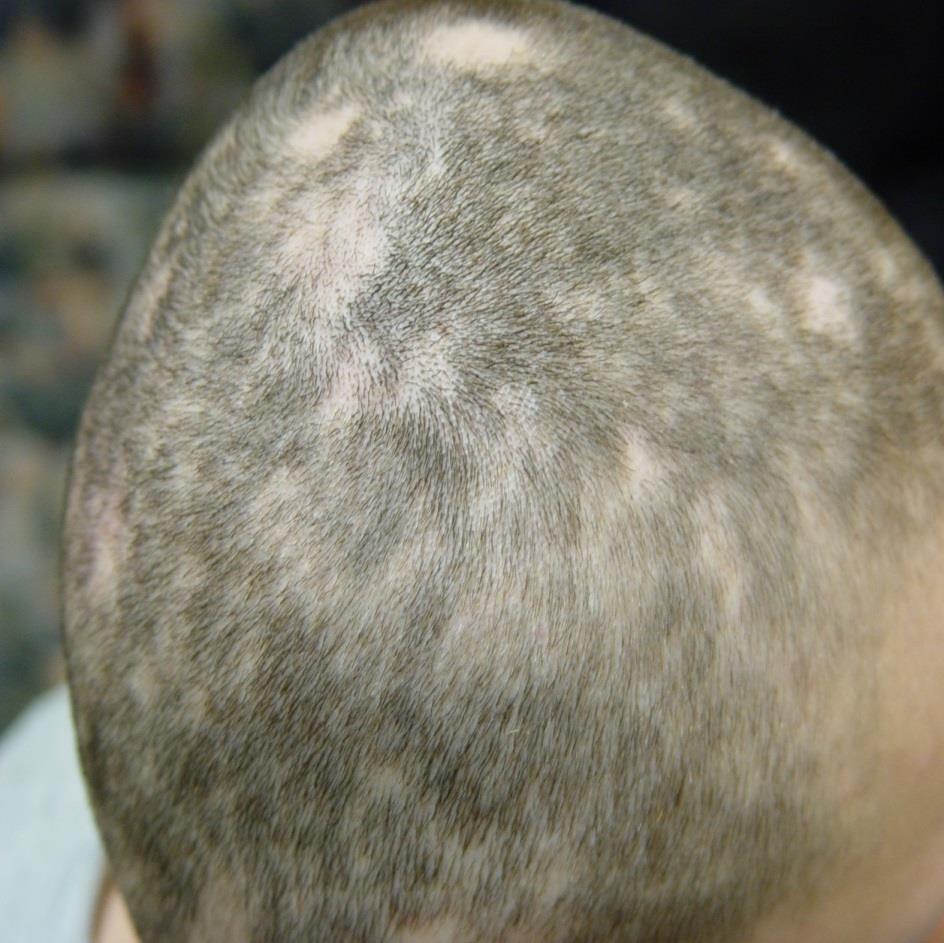 Alopecia Definition Partial or complete loss of hair from where it would