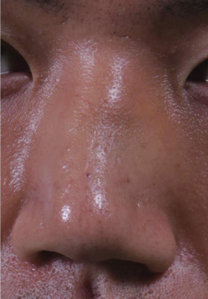Vol. 39 / No. 3 / May 2012 Fig. 5. ase of simultaneous dorsal augmentation rhinoplasty () 25-year-old male presented with nasal bone fracture with a low nasal dorsum.