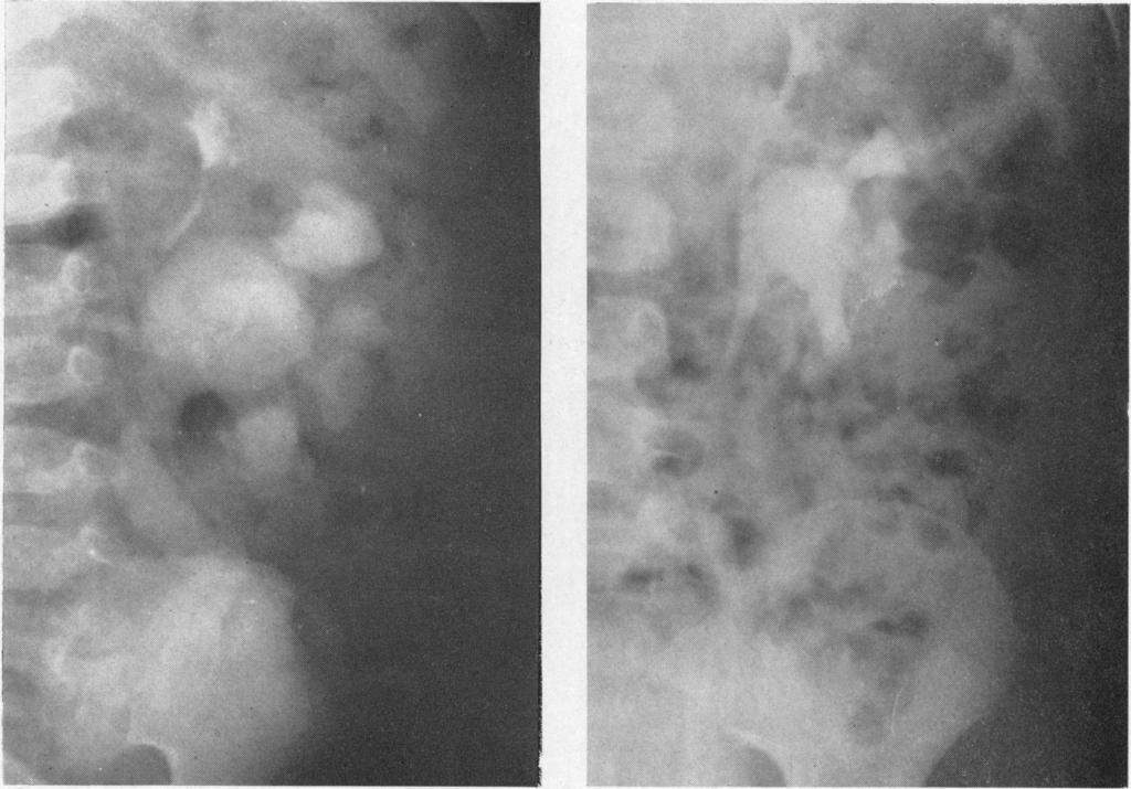 184 ARCHIVES OF DISEASE IN CHILDHOOD (a) Aged 2 months; hydronephrosis and ureteric dilatation affecting the main pyelon. FIG. 5.-The infective megaureter; intravenous pyelograms in girl.