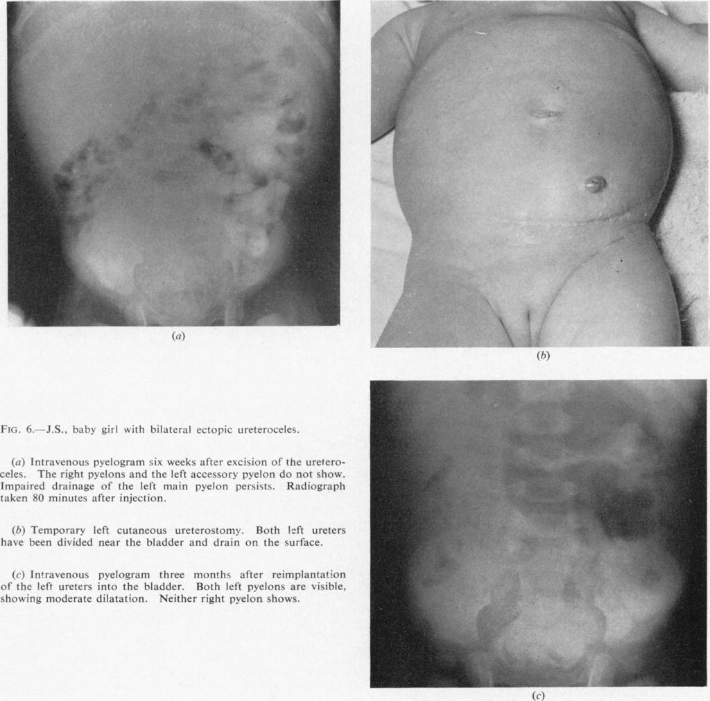 URINARY TRACT DUPLICATION IN CHILDHOOD 187 (a) FvG. 6.--J.S., baby girl with bilateral ectopic ureteroceles. (a) Intravenous pyelogram six weeks after excision of the ureteroceles.