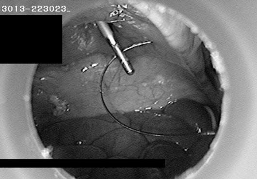 38 MI Seleem and AM Al-Hashemy Fig. 3. 2 mm grasper is used to bring the thread via a 2 mm port site, outside the abdominal cavity. Fig. 4.