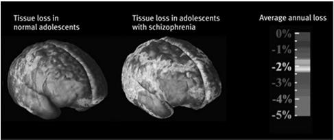 Chronic and Acute Schizophrenia When schizophrenia is slow to develop (chronic/process) recovery is doubtful. Such schizophrenics usually display negative symptoms.