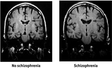 Understanding Schizophrenia Schizophrenia is a disease of the brain exhibited by the symptoms of the mind.
