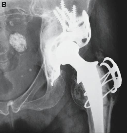 arthroplasty with massive acetabular bone loss.