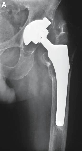276 Hamadouche et al. Fig. 4. (A) Preoperative radiograph of patient with failed total hip arthroplasty and large areas of cavitary proximal femoral bone loss.