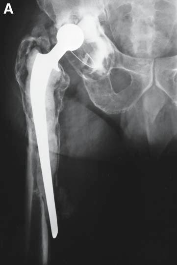 Bone Grafting for Total Joint Arthroplasty 277 Fig. 5. (A) Radiograph of failed total hip arthroplasty with severe proximal femoral bone loss.