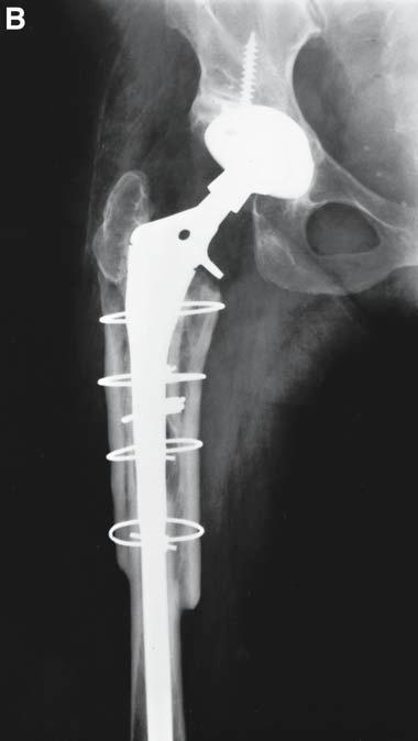 278 Hamadouche et al. Fig. 6. (A) Radiograph of failed total hip arthroplasty with proximal femoral osteolysis and periprosthetic fracture.