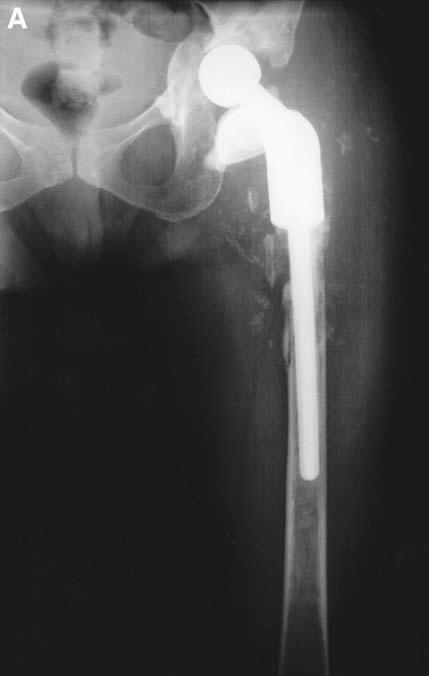 Bone Grafting for Total Joint Arthroplasty 279 Fig. 7. (A) Radiograph of failed total hip arthroplasty with loose femoral tumor prosthesis.