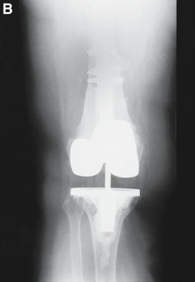 282 Hamadouche et al. Fig. 8. (A) Radiograph of patient with nonunion of supracondylar femur fracture above total knee arthroplasty.