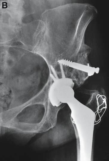 Particulate Grafts Particulate grafting of cavitary defects on the acetabular side can be performed in association with cemented or cementless cups.