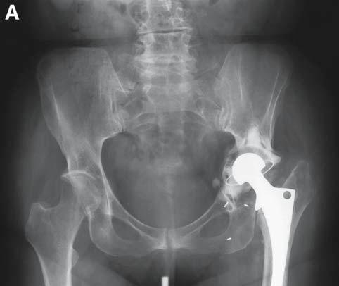 Bone Grafting for Total Joint Arthroplasty 271 Fig. 2. (A) Preoperative radiograph of patient with failed left total hip arthroplasty with acetabular bone loss.