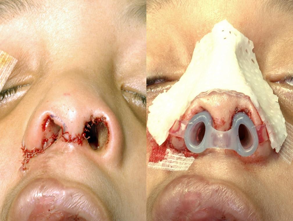A control group consisting of 16 children with no cleft lip or nasal deformity aged 6 to 8 years was also studied to confirm that the measurement technique demonstrated nasal symmetry in control