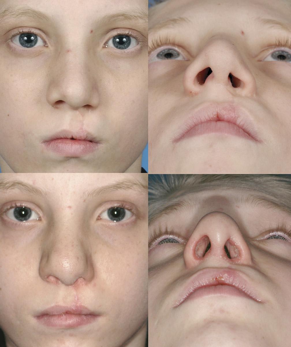 The Journal of Craniofacial Surgery & Volume 20, Supplement 2, September 2009 Cleft Rhinoplasty at Primary School Age continued for up to 6 months should the patient tolerate it.